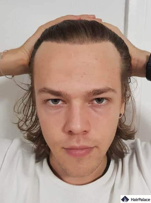 3000 hair graft results